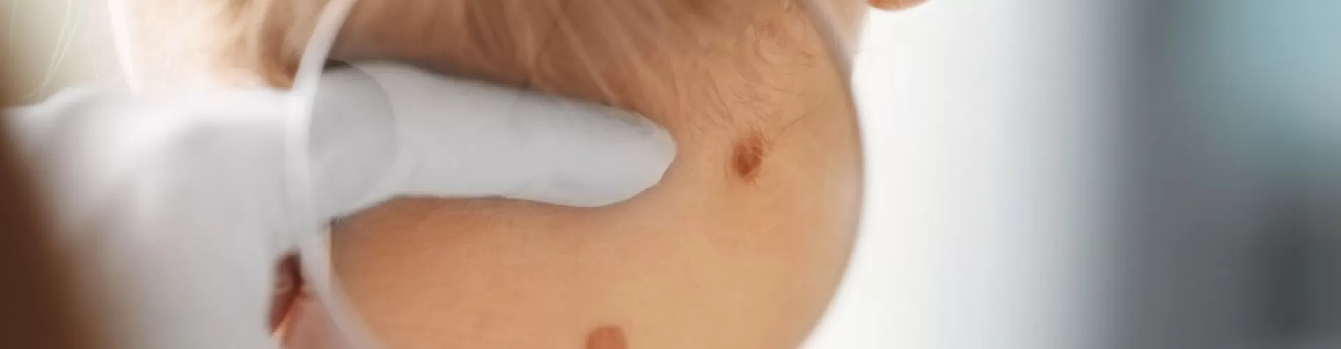 Removal of Skin Lesions