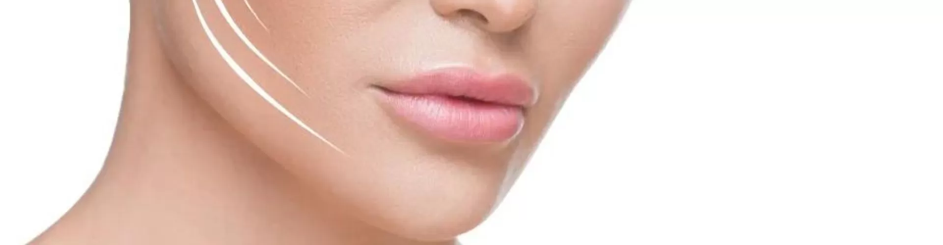 Endolift