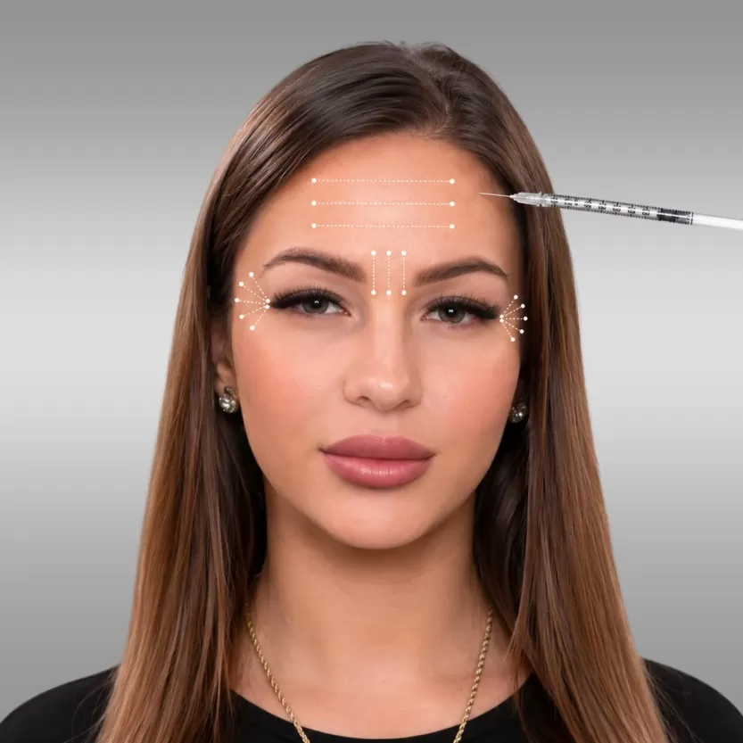 B0T0X treatment for expression lines
